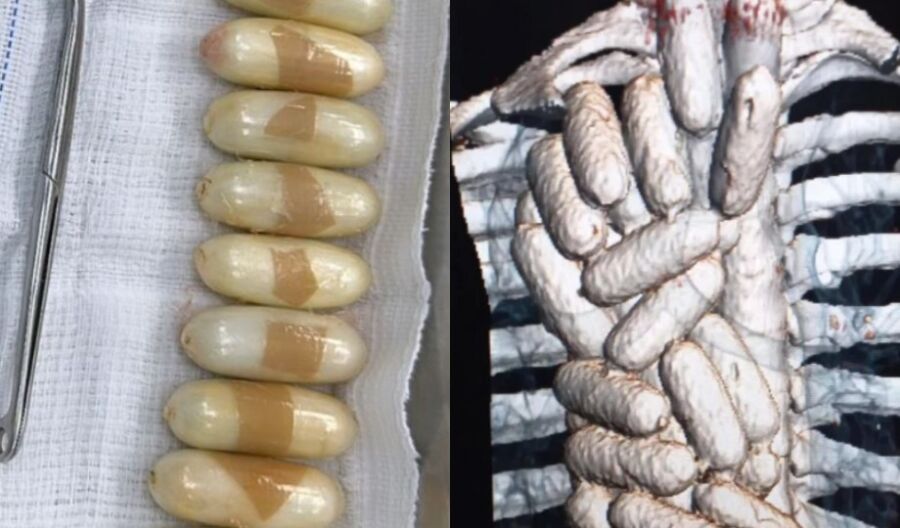 Mulher engole mais de 50 cápsulas de drogas e é internada às pressas em Manaus