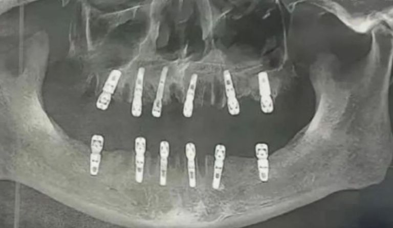 extracao-dentes-768x447