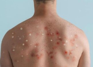 Brasil registra primeiro caso da nova cepa de Mpox