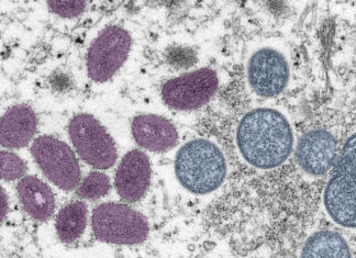 Brasil registra primeiro caso de mpox pela cepa 1b em paciente de São Paulo