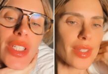 Carolina Dieckmann mostra reação alérgica na boca: ‘Toda queimada’