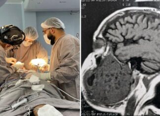 Hospital Adriano Jorge realiza procedimento inédito, ao remover tumor de mais de 2 kg, de mandíbula de paciente em Manaus