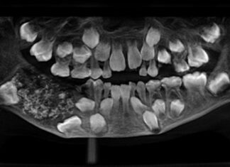 Menino de 7 anos passa por cirurgia e tem 526 dentes retirados