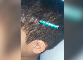 Aluno de 9 anos é ferido com lápis na cabeça após agressão de colega em escola