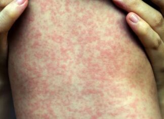 Opas alerta: Casos de sarampo tiveram aumento de 34 vezes em 2025