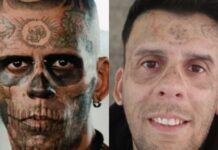 Ex-“homem mais tatuado do Brasil” passa por remoção de tatuagens no rosto