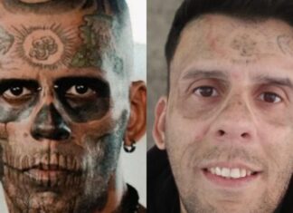 Ex-“homem mais tatuado do Brasil” passa por remoção de tatuagens no rosto