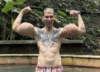 Influencer russo chamado de “Popeye” pode ter braços amputados após uso de substância perigosa