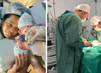 Gêmeos siameses recém-nascidos morrem após cirurgia de separação