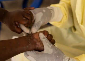 Brasil registra 88 casos de Mpox em 2026; São Paulo lidera com 62 infecções