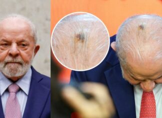 Lula inicia radioterapia após retirada de câncer de pele