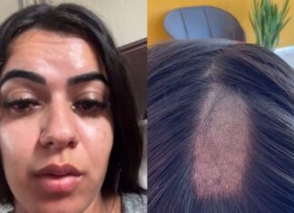 Mulher denuncia clínica após ter cabelo raspado em exame toxicológico para renovação da CNH